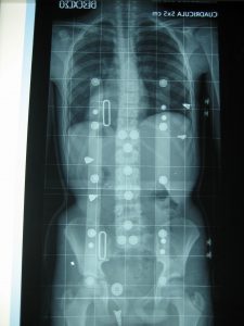 Radiografía de columna