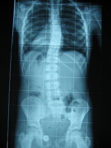 Radiografía de columna